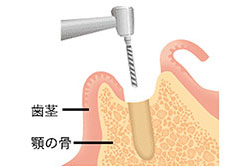 STEP4 インプラント埋入