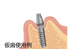 STEP 5 固定期間