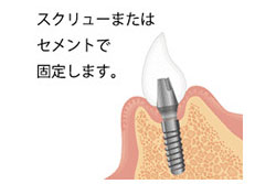 STEP 7 上構造部の連結