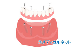 その5 骨造成治療やAll-on-4などに対応