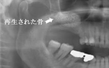 サイナスリフトオペ後