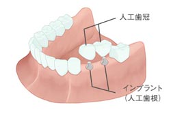 人工の歯根を顎の骨の中に埋め入れる「インプラント」