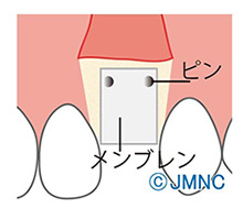 GBR法