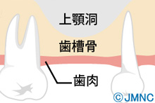 上顎洞