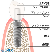 インプラントの構造