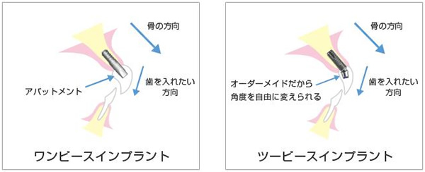 ワンピース&ツーピースインプラント
