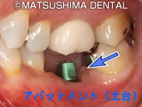 セラミックなどの人工の歯冠を製作します