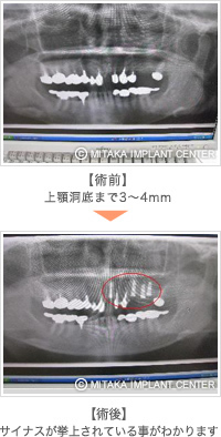 サイナスインパクションを行った治療例