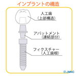 インプラント 構造