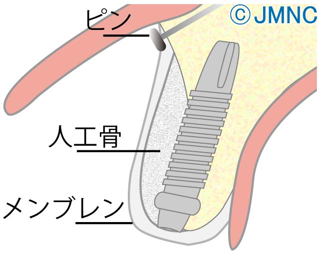 GBR法(骨誘導再生法)