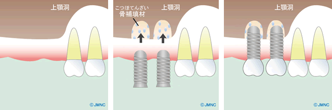 ソケットリフト