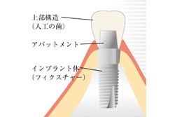 インプラント治療について