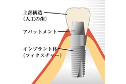 インプラント治療について