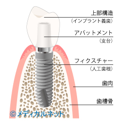 インプラント治療で噛む機能を改善