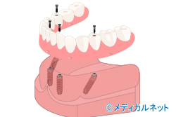 すべての歯を失った場合に行うAll-on-4(オールオンフォー)