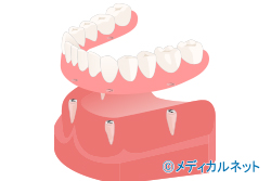 総入れ歯が安定しない場合に適するインプラント治療