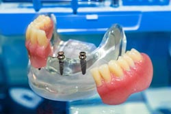 本物歯の代わりとして使用できる