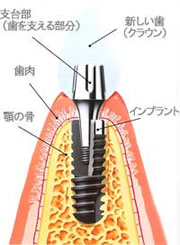 インプラント治療について