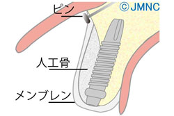 GBR法(骨再生療法)