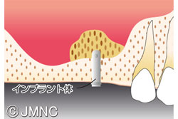 ソケットリフト法