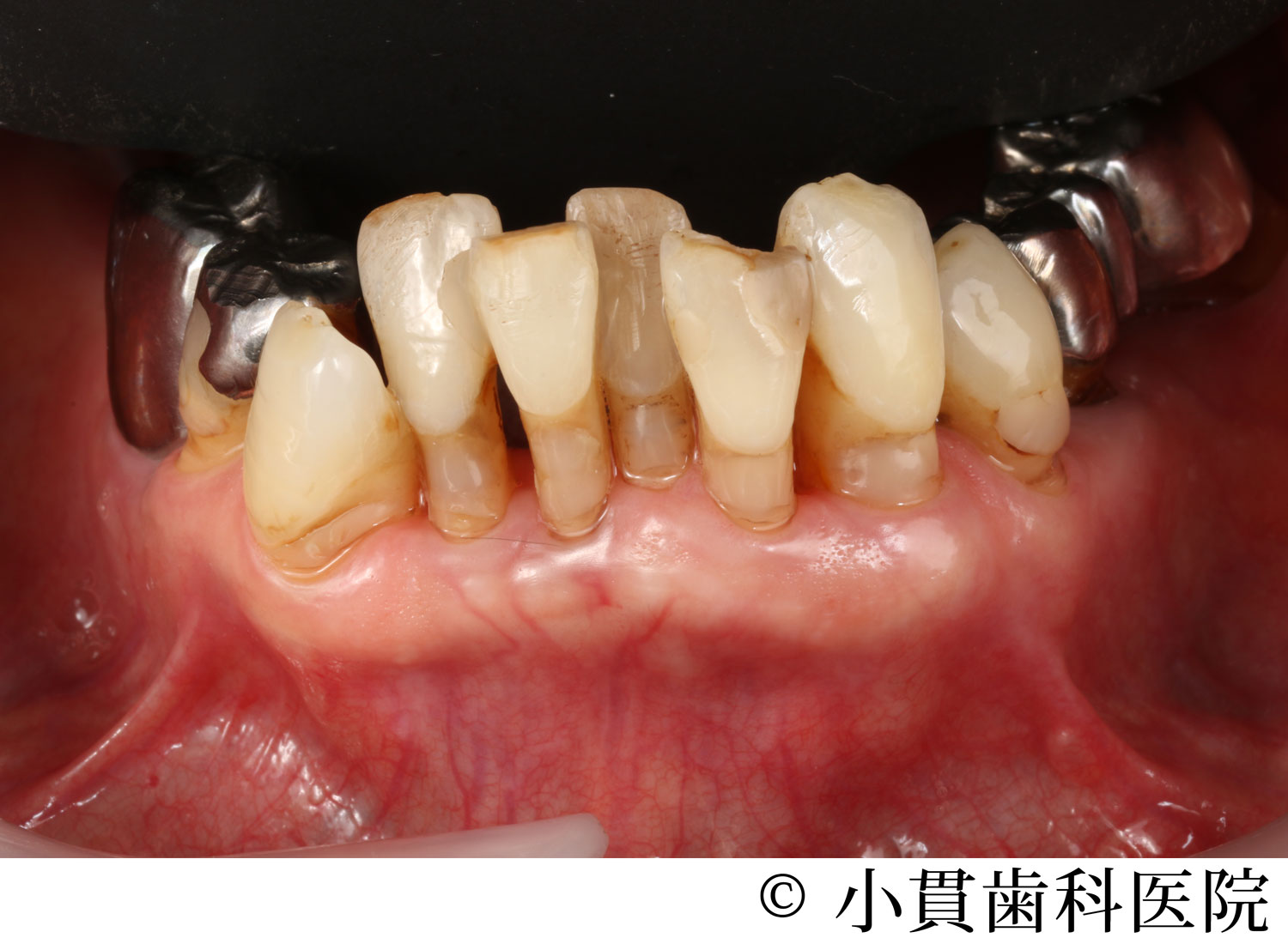 治療前