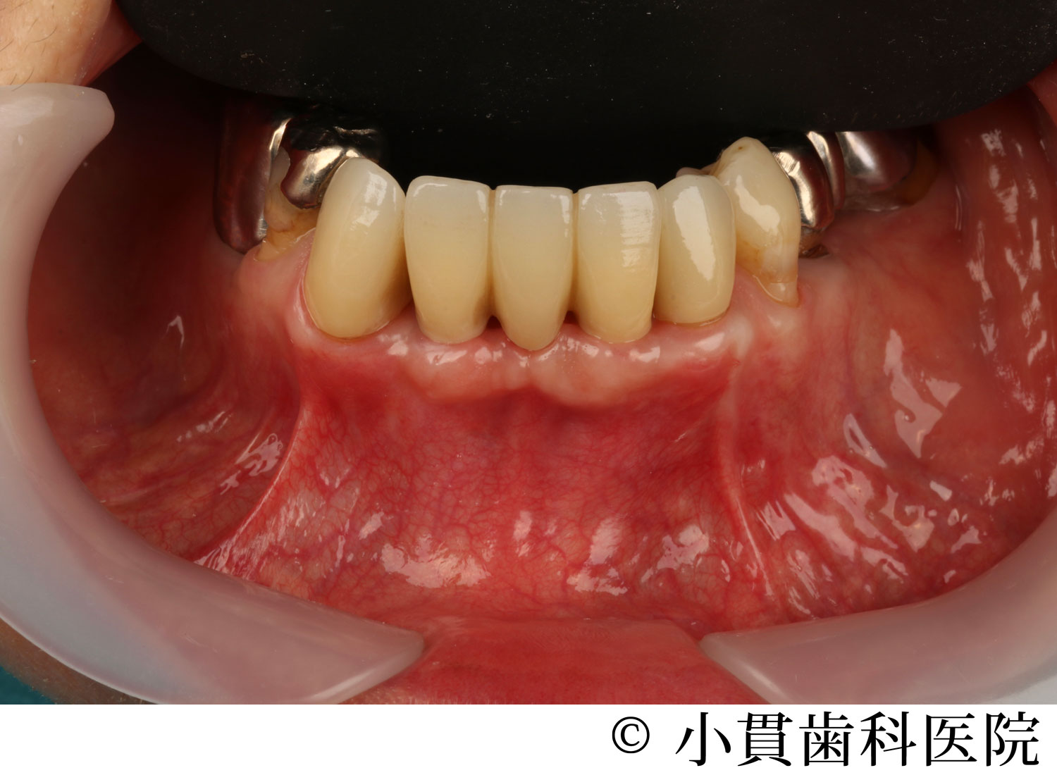 治療後