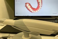 3Dスキャナでの型取り