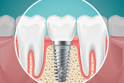 インプラント治療とは