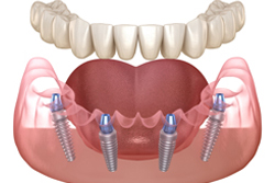 ������˥å���All-on-4�ʥ����륪��ե�����