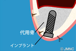 ソケットリフトとサイナスリフト