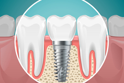 インプラント治療とは