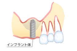 サイナスリフト