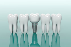 天然歯の保存を第一に考えた上でインプラント治療を提供