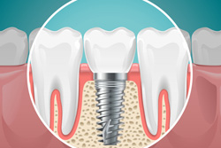 重度の歯周病や骨不足などにも対応