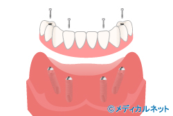 5.All-on-4(륪ե)