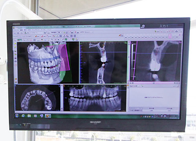 無料で行うカウンセリング・歯科用CT撮影・3Dシミュレーション