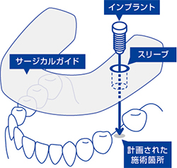 「サージカルガイド」で適切な施術を