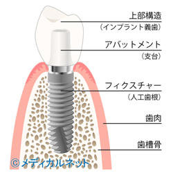 インプラントとは?