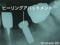 ҡ󥰥Хåȥ