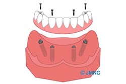 All-on-4�ˤĤ���