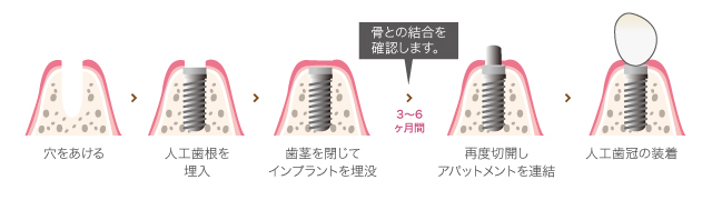1回法
