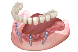 All-on-4�ˤĤ���