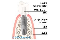 2次手術(アバットメントの取りつけ)