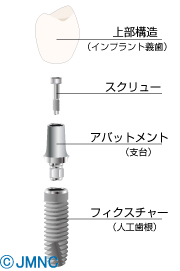 インプラントの構造