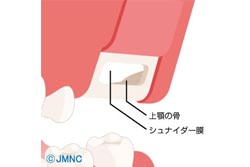 【サイナスリフト】