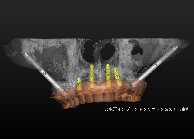 ザイゴマインプラントに対応