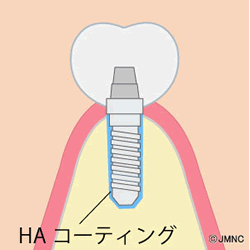 骨との結合を早めるHAインプラント