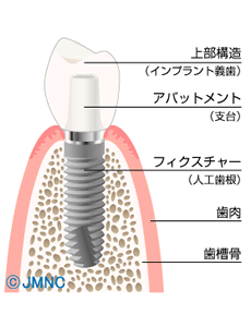 インプラント治療について
