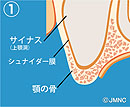 サイナスリフト