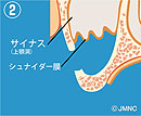 サイナスリフト